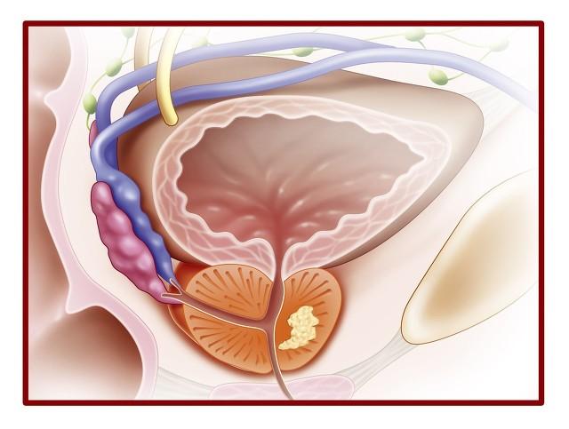 前列腺增生手術(前列腺電切術的利弊)插圖